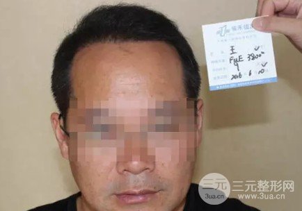 補(bǔ)發(fā)植發(fā)是真的有嗎