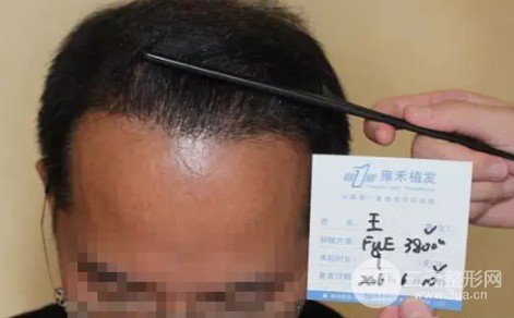 補(bǔ)發(fā)植發(fā)是真的有嗎