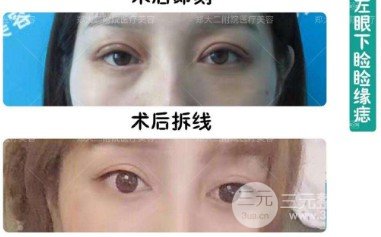 上瞼下垂術(shù)后12天圖片