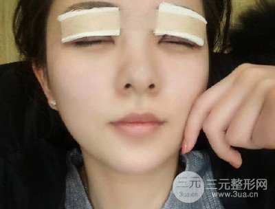 上瞼下垂術(shù)后12天圖片