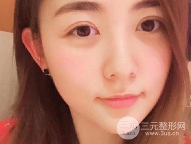 上瞼下垂術(shù)后12天圖片