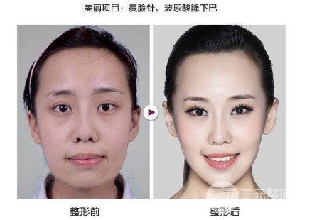 打注射瘦臉好嗎