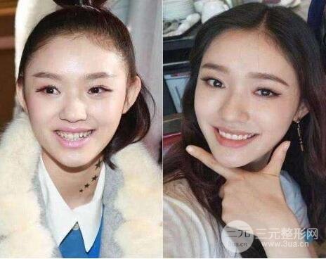 整牙真的能變漂亮嗎?