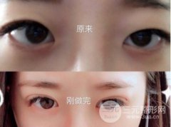 韓式微創(chuàng)雙眼皮過程，圖解手術(shù)前后對(duì)比