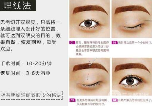 埋線(xiàn)雙眼皮
