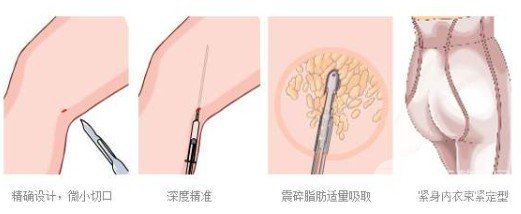 等離子激光溶脂果如何