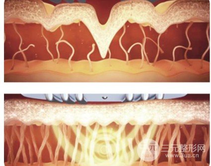 等離子激光溶脂果如何