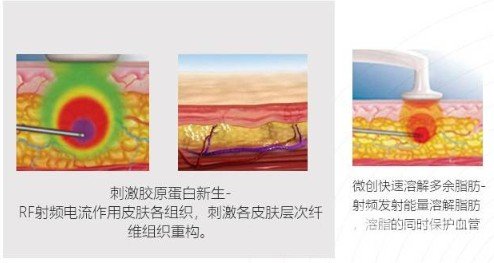 等離子激光溶脂果如何