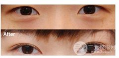疼痛感較輕雙眼皮不動(dòng)刀是不是長(zhǎng)時(shí)間的？全切可能更適合你~