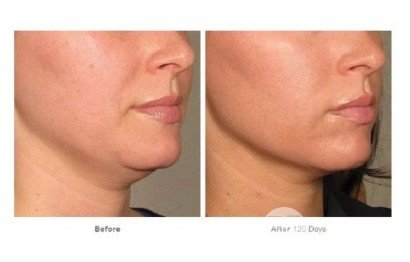 熱瑪吉是什么美容項(xiàng)目