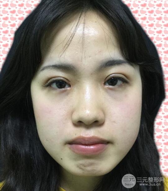 耳軟骨墊鼻尖失敗照片|鼻修復(fù)經(jīng)歷，鼻子第二次重生~