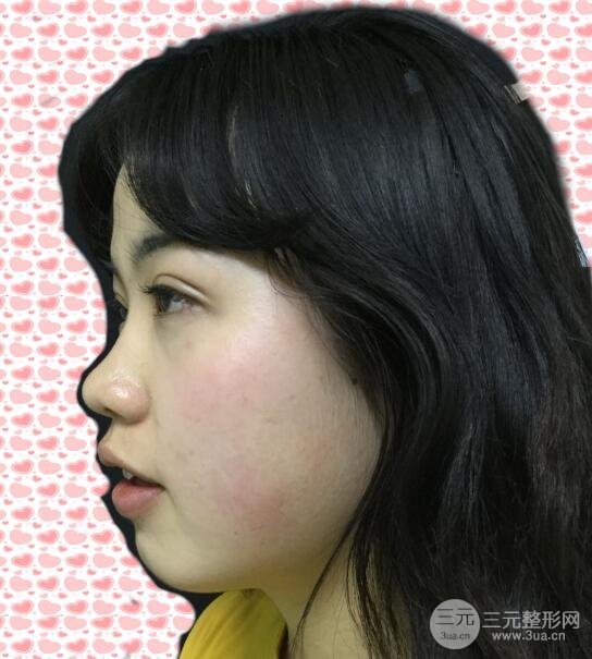 耳軟骨墊鼻尖失敗手術(shù)前