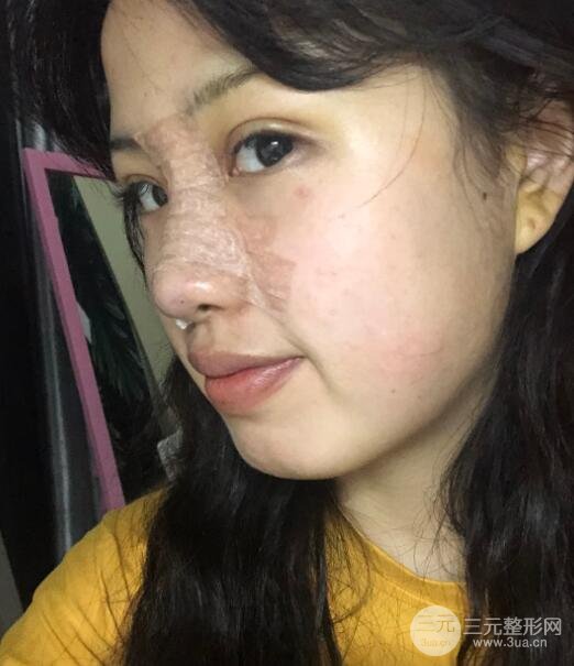 耳軟骨墊鼻尖失敗手術(shù)前