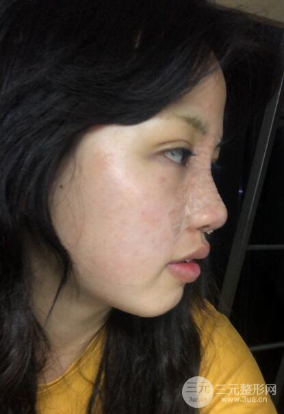 耳軟骨墊鼻尖失敗手術(shù)前