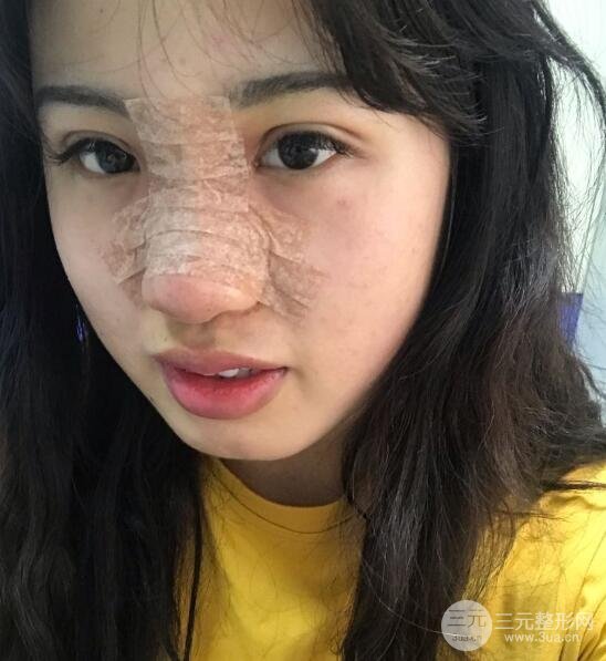 耳軟骨墊鼻尖失敗手術(shù)時(shí)