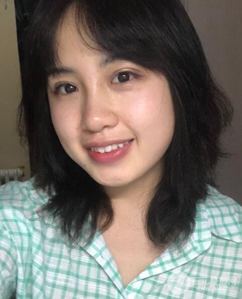 耳軟骨墊鼻尖失敗手術(shù)時(shí)