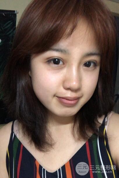 耳軟骨墊鼻尖失敗手術(shù)后