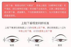 上瞼下垂術后注意事項，這些基礎操作別忘了