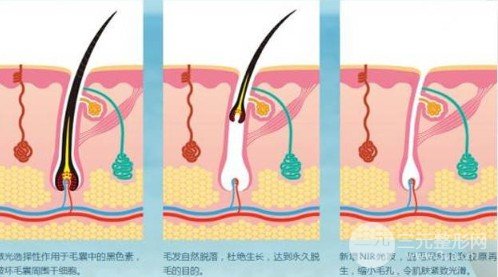 光子脫毛的危害有哪些