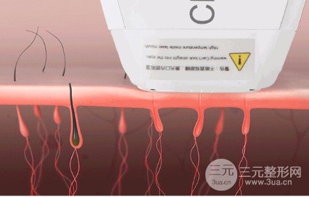 光子脫毛的危害有哪些