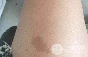 如何去掉胎記