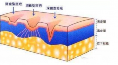 激光祛痘祛斑能同時做嗎？會有副作用嗎？