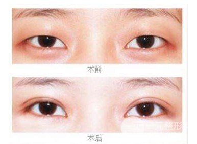韓式微創(chuàng)雙眼皮是埋線嗎