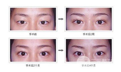 韓式微創(chuàng)雙眼皮是埋線嗎