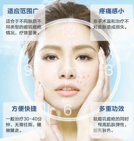 光子緩解痤瘡需要幾次