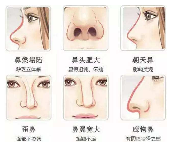 假體隆鼻手術(shù)降低風(fēng)險(xiǎn)嗎