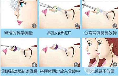 假體隆鼻手術(shù)降低風(fēng)險(xiǎn)嗎