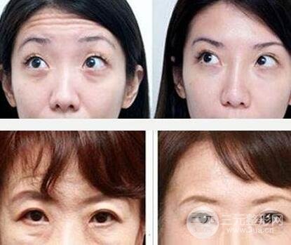 怎么樣去除抬頭紋