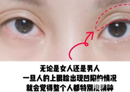 玻尿酸眼窩填充需要幾支