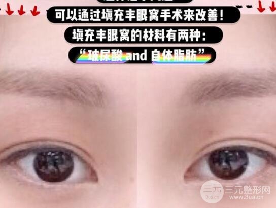 玻尿酸眼窩填充需要幾支