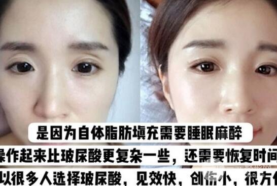 玻尿酸眼窩填充需要幾支