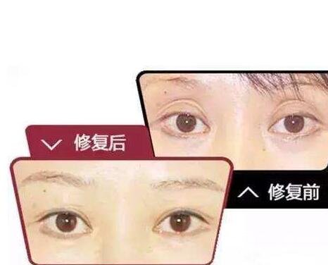 玻尿酸眼窩填充需要幾支