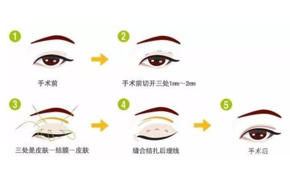 微創(chuàng)雙眼皮多久恢復(fù)自然