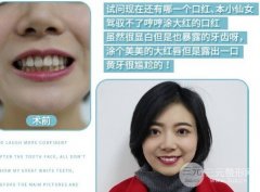 全瓷牙貼面能撐多久？全瓷牙壽命延長(zhǎng)指南