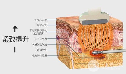 等離子激光溶脂副作用