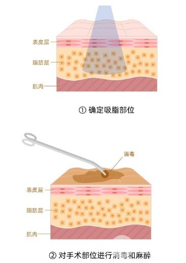 吸脂去眼袋成好嗎