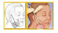 大拉皮的疤痕什么時(shí)候能去掉？會很明X嗎?