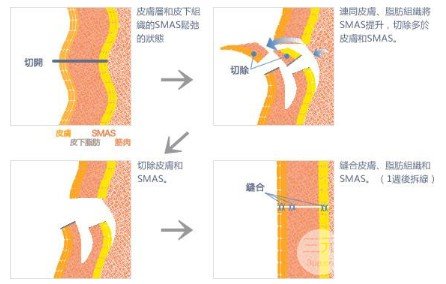 大拉皮手術(shù)少錢