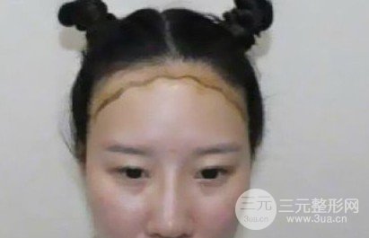 河南植發(fā)正規(guī)醫(yī)院收費(fèi)標(biāo)準(zhǔn)