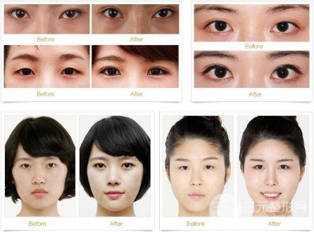 開(kāi)眼角疤痕怎么形成