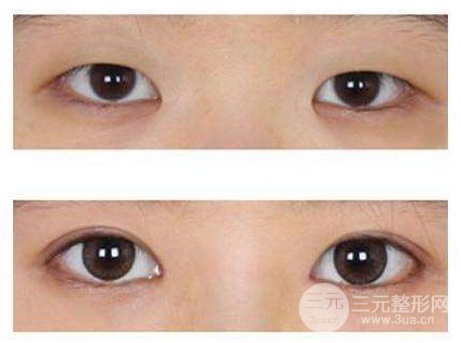 開(kāi)眼角疤痕怎么形成