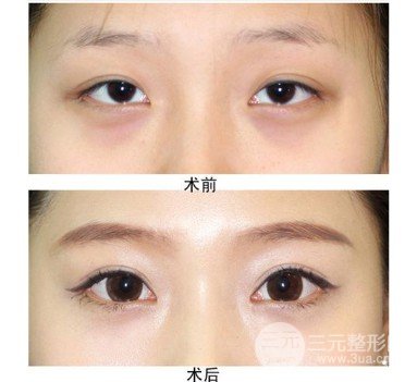 開(kāi)眼角疤痕怎么形成