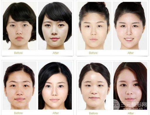 開(kāi)眼角疤痕怎么形成