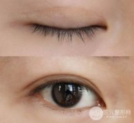 疼痛感較輕雙眼皮真的不痛嗎？雙眼皮有疤是大夫技術(shù)不行?