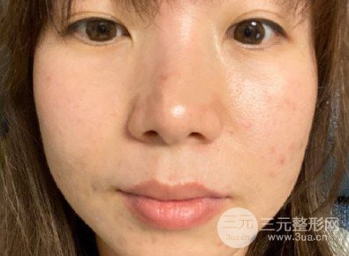 光子嫩膚祛痘印果