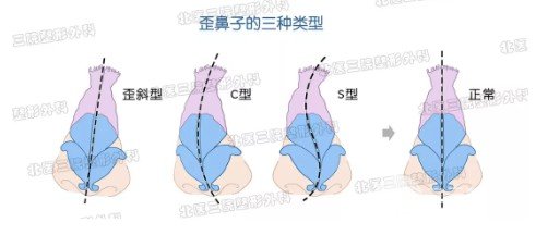 鼻子歪了如何矯正